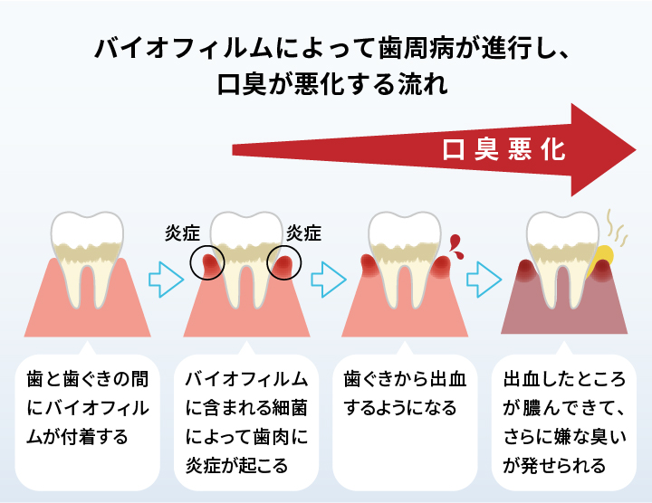 歯周病 進行 口臭